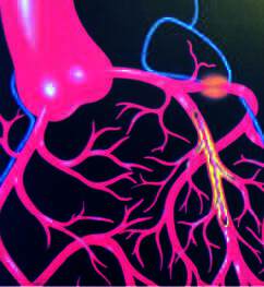 Det var engelskmannen William Withering (1741–1799) som dokumenterte effekten av digitalis på ødemer og hjertesvikt. Hjertesvikt kan skyldes en rekke årsaker. Forkalkninger eller forsnevringer av hjertets kransarterier er ofte involvert som antydet på denne illustrasjonen. For virkningsmekanismer, se tekst. Fra Ajanki: Medicinal Reading.